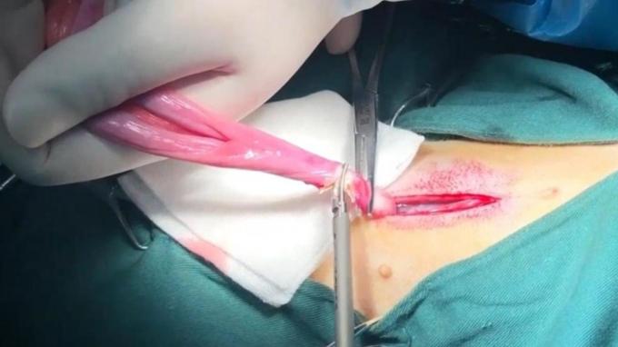 son şirket davası hakkında Kısırlaştırma ve Kısırlaştırma Cerrahisinde Pet Ultrasonik Neşter Kullanımı | Surgsci 0