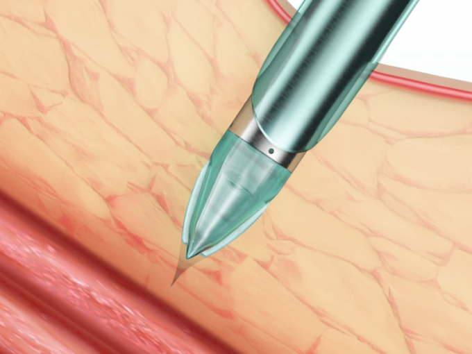 hakkında en son şirket haberleri Endopass Tek Kullanımlık Laparoskopik Trokarın Özellikleri Ve Faydası | SurgSci  1