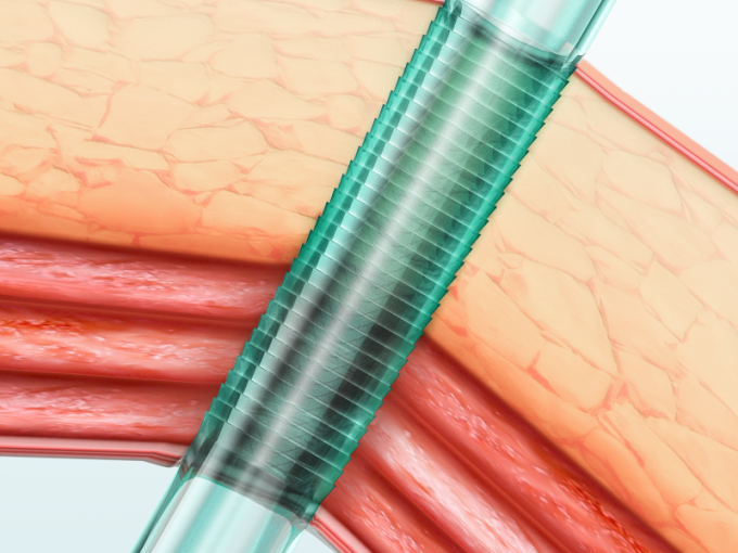 Tek Kullanımlık 5mm Optik Trokar Sınıf II Laparoskopik Trokar ve Kanül 0