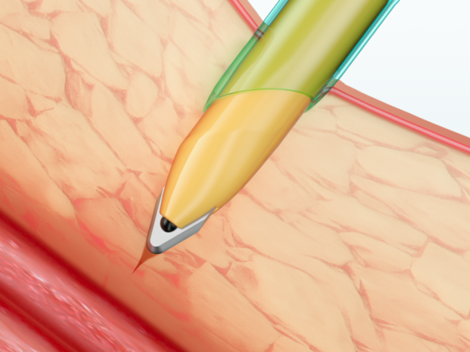 Laparoskopik Aletler Bıçaklı Tek Kullanımlık Trokar Kanül 1