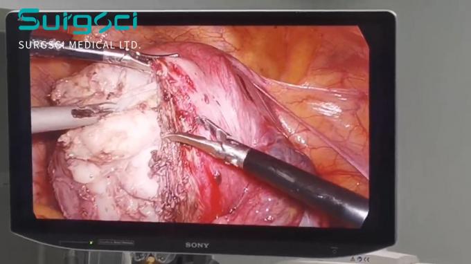 hakkında en son şirket haberleri Rahim Lezyonlarını Anlamak: Nedenleri ve Tedavi Seçenekleri | Surgsci  0