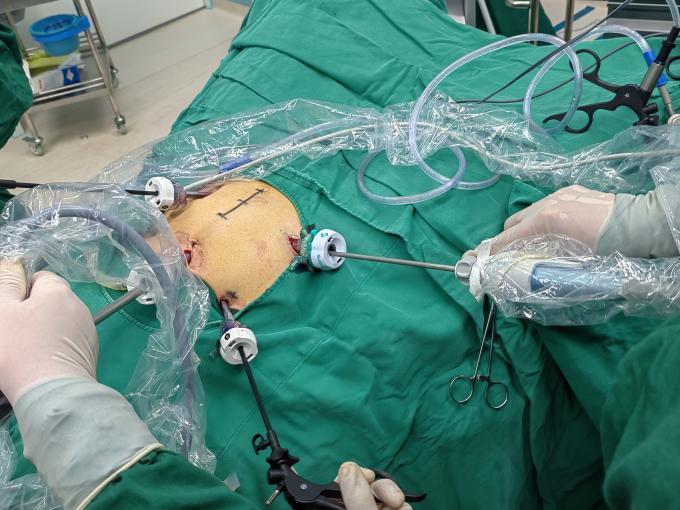 son şirket davası hakkında SurgSci Laparoskopik Trokar ve Ultrasonik Bisturi Kullanım Örneği | Surgsci  1