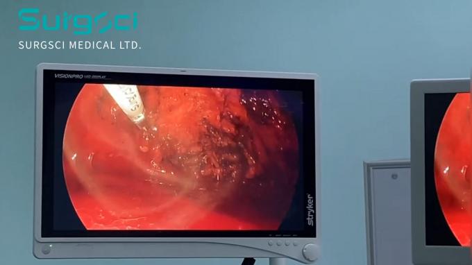 son şirket davası hakkında SurgSci Ultrasonik Neşter Kullanımda | Fıtık Onarımı | Surgsci  0